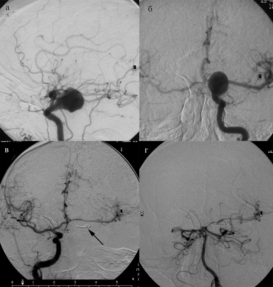 Ангиография мозга. Каротидная ангиография. Кт каротидная ангиография. Рентген-контрастная ангиография. Аневризма ангиография.